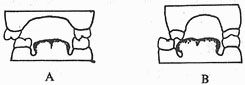 锁合