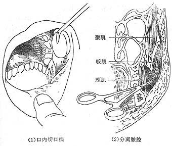 颊间隙感染