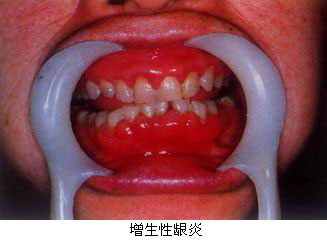 肺大性龈炎