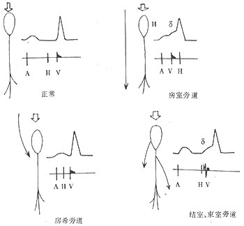 预计综合症
