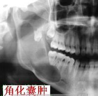 角化囊肿
