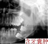 含牙囊肿
