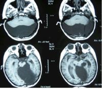 小脑蛛网膜囊肿 MRI