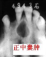 正中囊肿